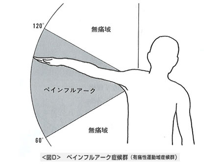 ペインフルアーク症候群（有痛性運動域症候群）