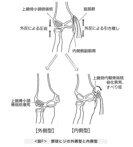 野球ヒジの外側型と内側型