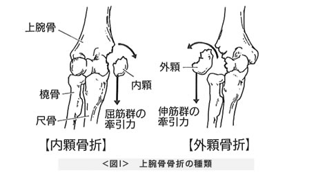 上腕骨骨折の種類