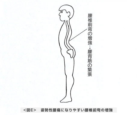 姿勢性腰痛になりやすい腰椎前弯の増強