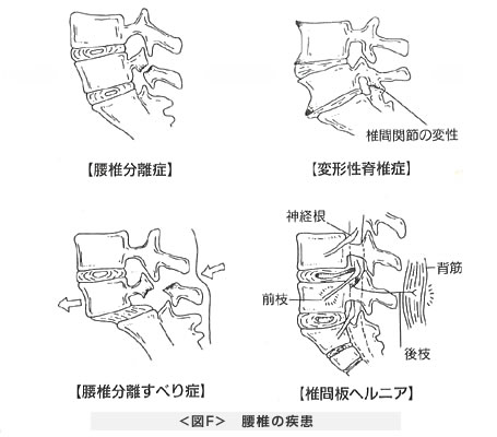 腰椎の疾患